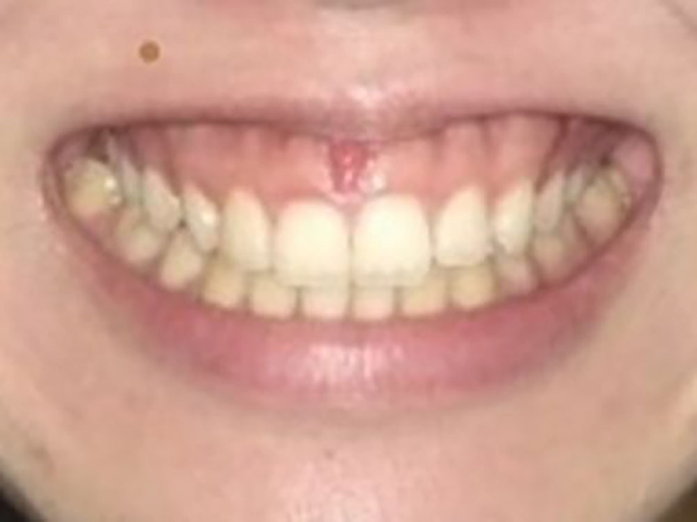笑っ た 時 歯茎