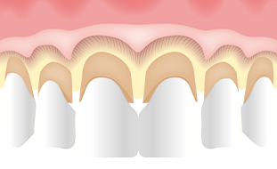 歯の境目と骨との距離を確認するイラスト