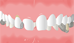 歯肉整形治療のイメージイラスト-ステップ1