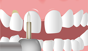 歯肉整形治療のイメージイラスト-ステップ2