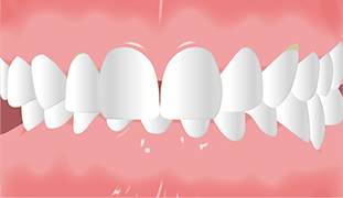 歯肉整形治療のイメージイラスト-ステップ3