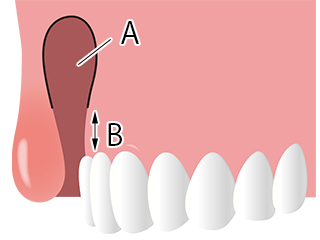 唇が原因の場合に歯茎の粘膜を摘除するイラスト