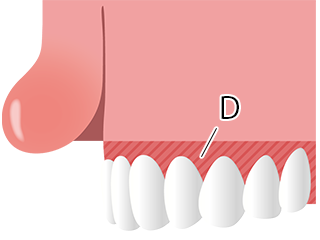 歯茎の露出範囲を示すイラスト