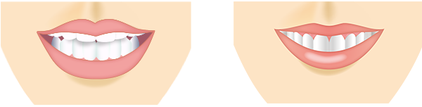 ガミースマイル治療前と治療後のイラスト