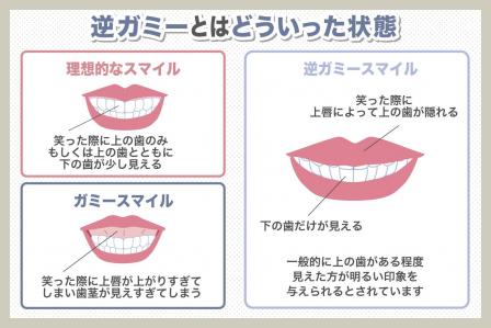 逆ガミーとは？笑っても歯が見えない場合の治療方法と自宅で出来る対策を紹介！