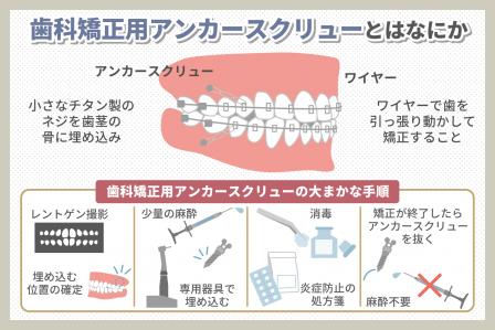 アンカースクリュー矯正ってどうなの？ガミースマイルの有効性を徹底解説