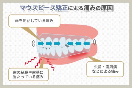 マウスピース矯正の痛みって何？対処法とNG行動を解説！