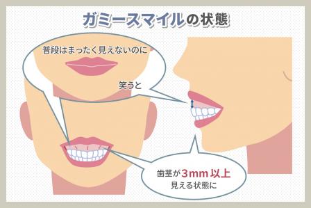 【症例写真】ガミースマイルになる5つの原因！6つの治療方法も解説