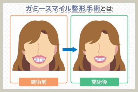 ガミースマイル整形手術で失敗しないための予備知識と病院の選び方を解説