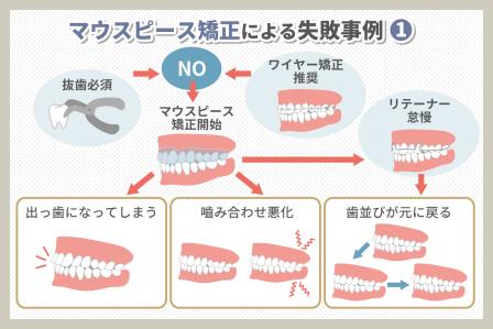 マウスピース矯正の失敗事例と対策方法の解説