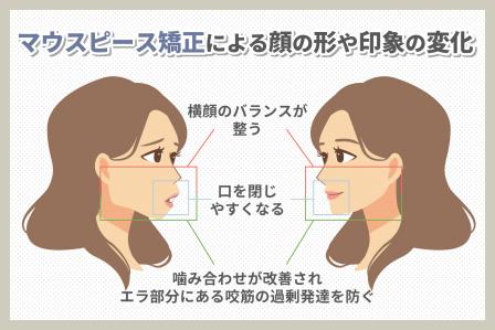 マウスピースは歯並びが整うだけじゃなく小顔にもなる！？　なぜ顔の形も変わるのか解説