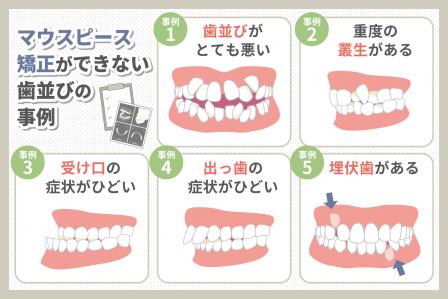 マウスピース矯正ができない歯並びは？イラスト付きで解説します