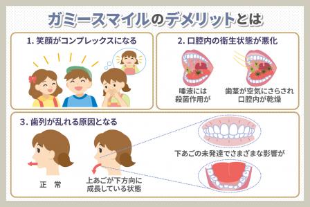 子供のガミースマイル矯正について解説！遺伝が原因！？