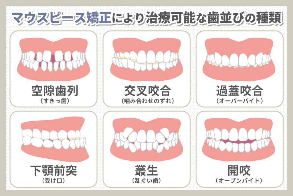 確認用 オープンマウス 歯有り 捌き