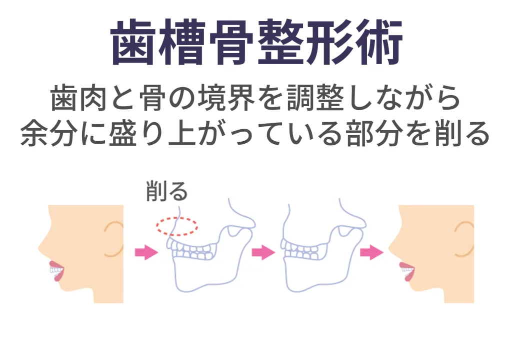 歯槽骨整形術
