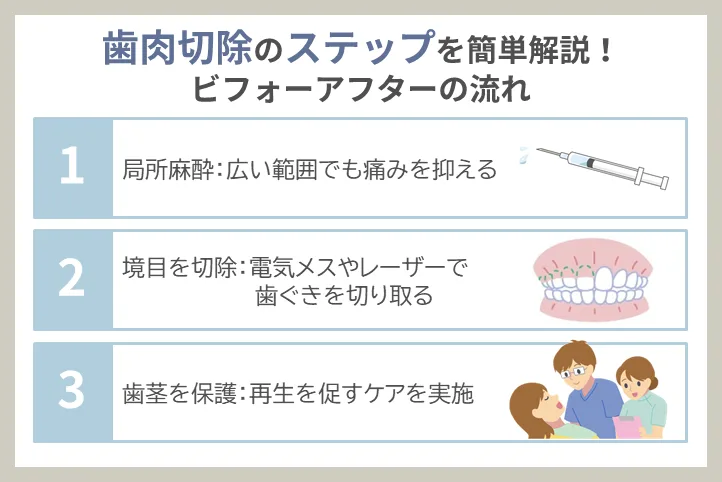 歯肉切除の手順:歯と歯ぐきの境目を切り取る方法