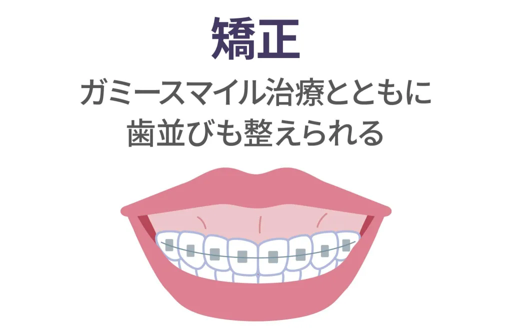 歯列矯正