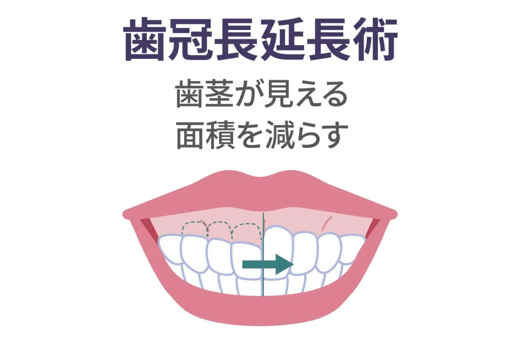歯冠長延長術