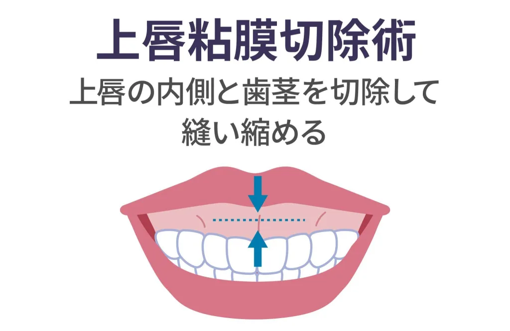 上唇粘膜切除術