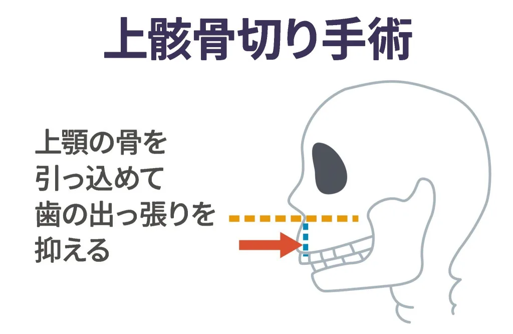 上顎骨切り手術