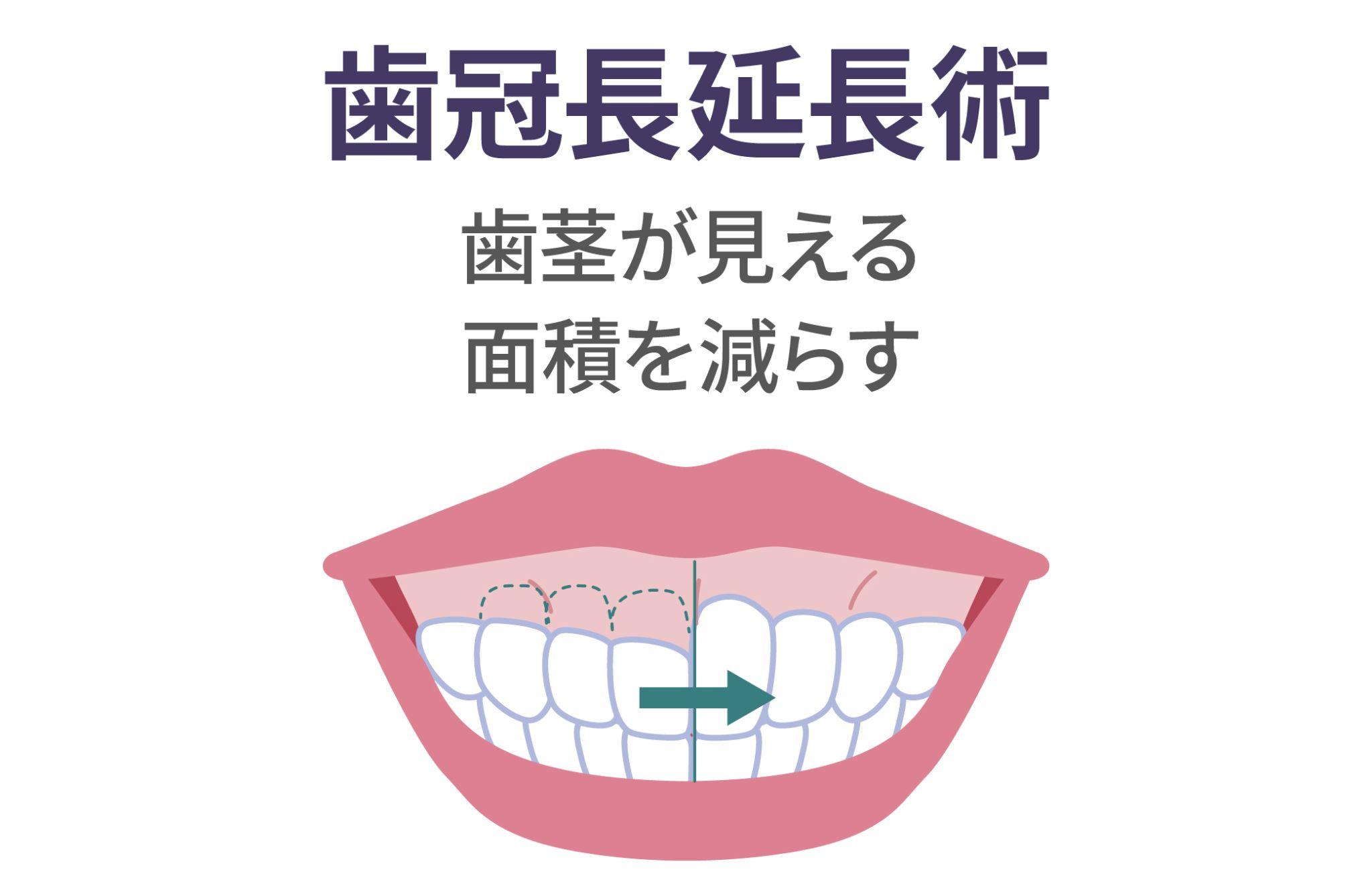 【専門医が徹底解説】ガミースマイルを改善する治療法「歯冠長延長術」ガイド