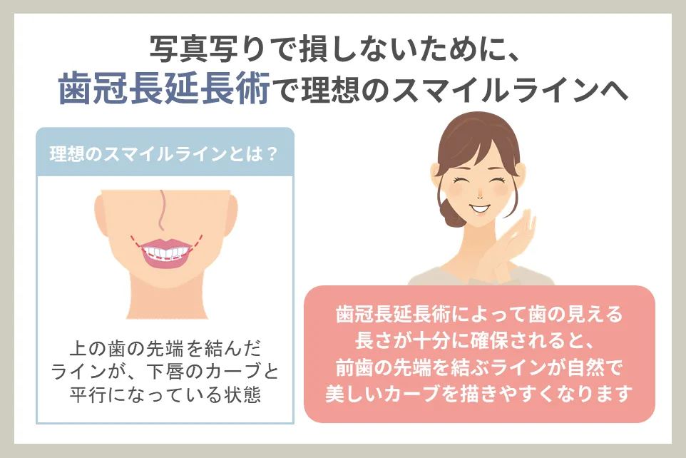 写真写りで損しないために、歯冠長延長術で理想のスマイルラインへ
