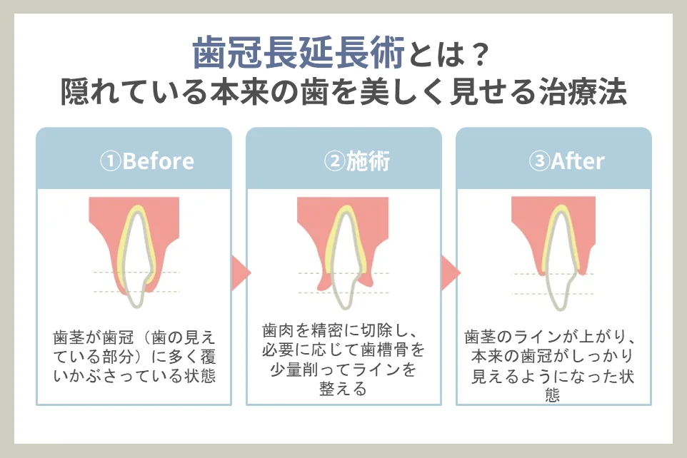 歯冠長延長術とは？隠れている本来の歯を美しく見せる治療法