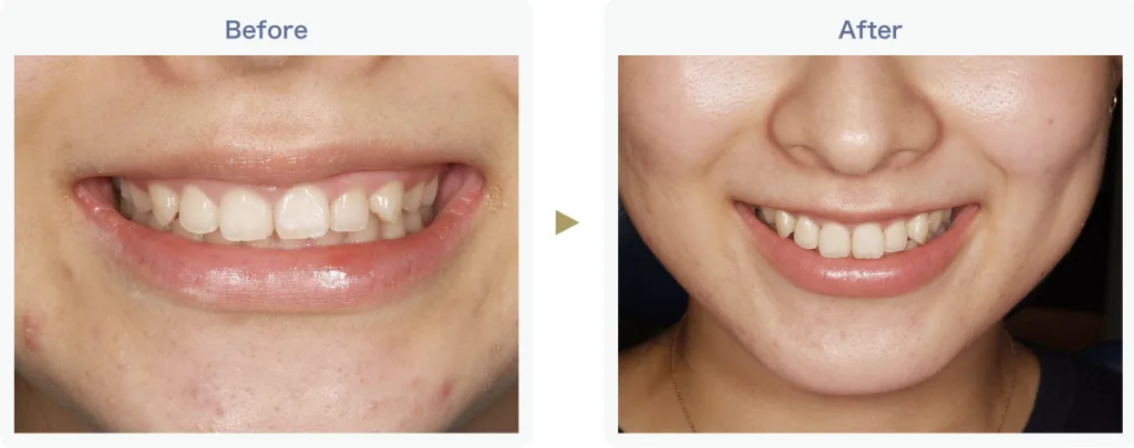 歯茎を切る手術（歯冠長延長術）ビフォーアフター1