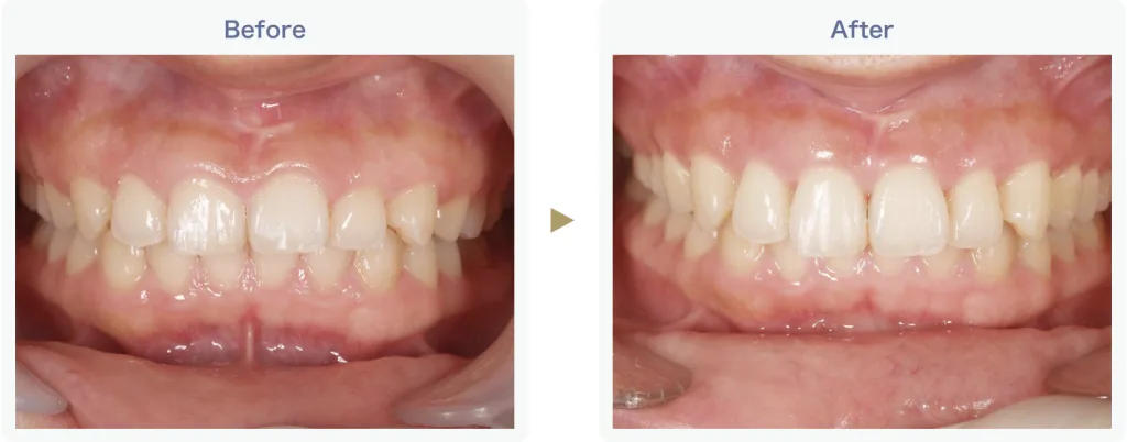 歯茎を切る手術（歯冠長延長術）ビフォーアフター2