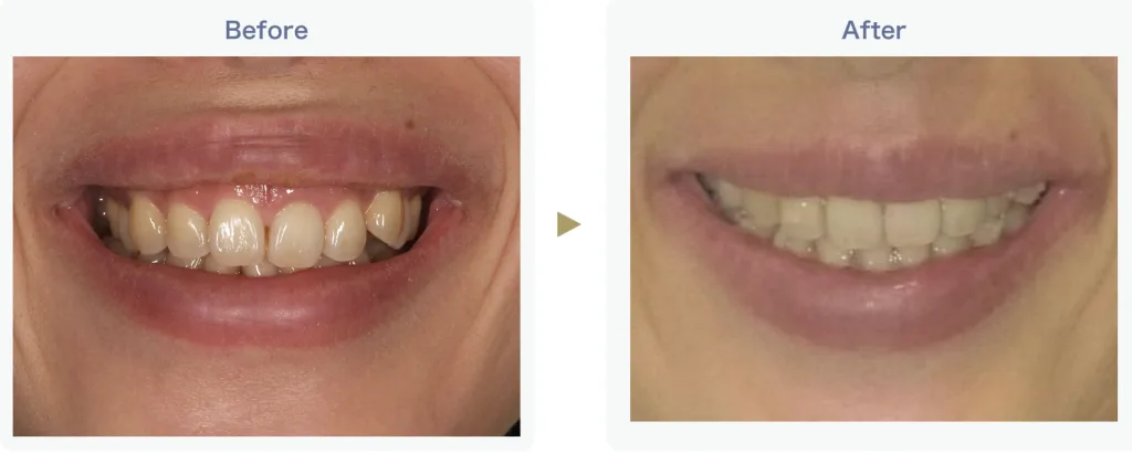 歯並びも整える矯正治療ビフォーアフター１