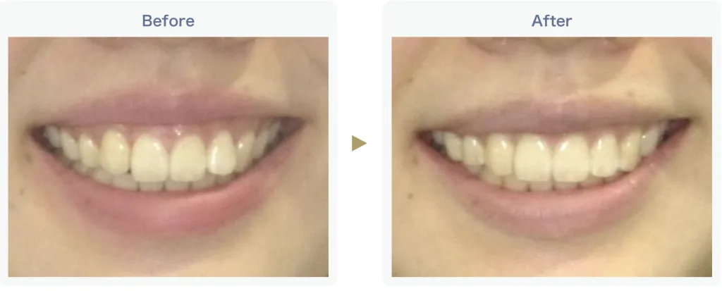 歯並びも整える矯正治療ビフォーアフター２