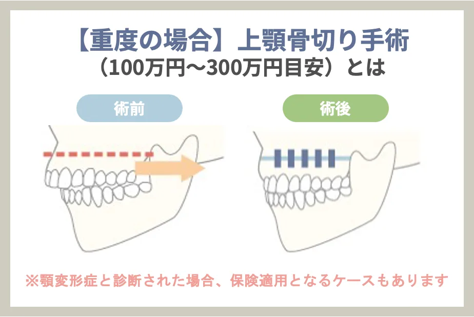 【重度の場合】上顎骨切り手術（100万円～300万円目安）とは