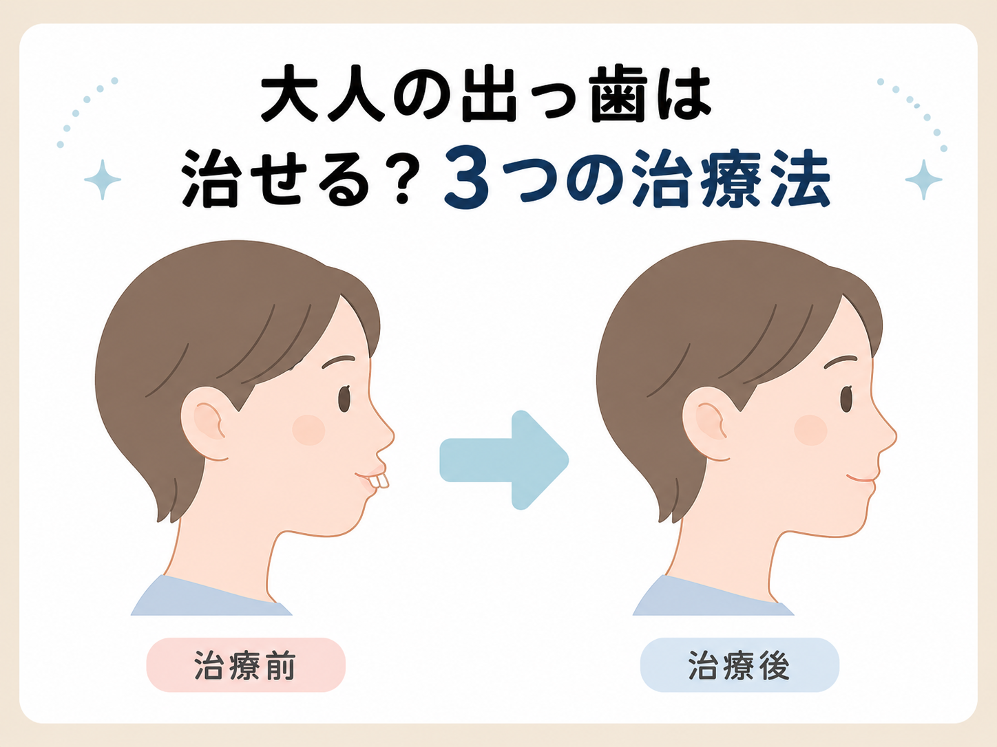 出っ歯の治し方｜大人でも治せる3つの方法と選び方を歯科医が解説